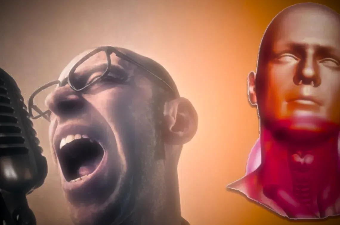 20_polipo alle corde vocali